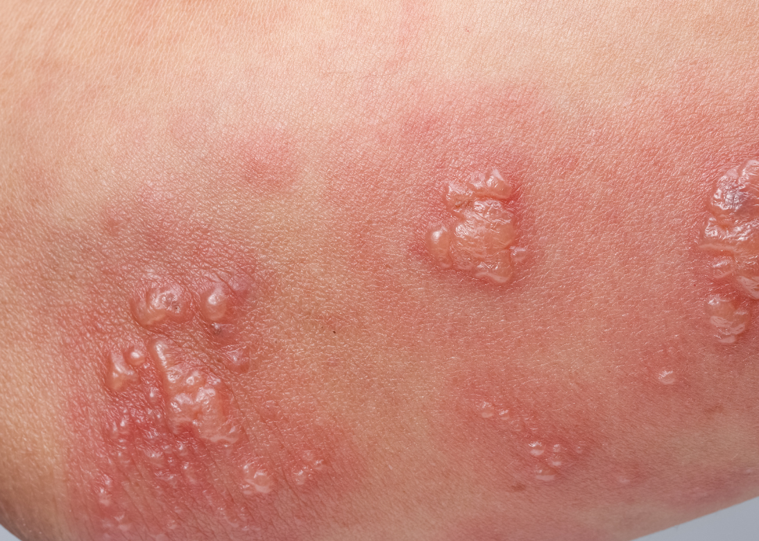 Urticaria